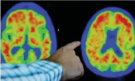  ?? Photograph: Brian Snyder/Reuters ?? Evidence of Alzheimer’s disease on PET scans.