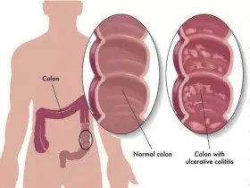  ??  ?? 正常结肠与溃疡性结肠­炎的区别
