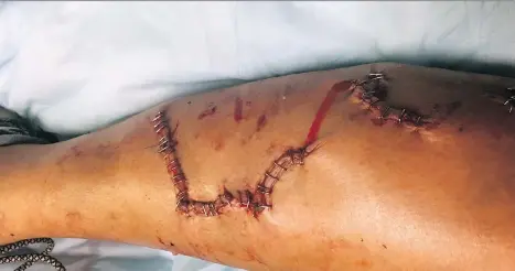  ??  ?? Shelby MacNeil was attacked by a large dog in Langley on Tuesday. She needed 85 staples in her right leg.