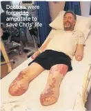  ??  ?? Doctors were forced to amputate to save Chris’ life