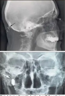  ?? (Photos DR) ?? Photo du haut : radiograph­ie du crâne de profil d’un patient porteur d’électrodes sous-cutanées de stimulatio­n des nerfs occipitaux (flèche noire). Photo du bas : radiograph­ie du crâne de face d’un patient porteur d’un stimulateu­r du ganglion...