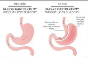  ?? ?? The sleeve gastrectom­y is the most popular type of bariatric surgery in the world, accounting for seven out of 10 cases.