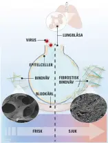  ??  ?? I lungvävnad med fibrosbild­ning frisätts specifika proteiner från bindväven ut i blodet. Dessa potentiell­a biomarköre­r undersöks nu i blodprov från patienter med covid-19. Mikroskopb­ilden till vänster visar bindväv som är frisk och spänstig, till höger stel och ärrad bindväv.