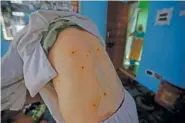  ?? AP PHOTO/MUKHTAR KHAN ?? Kashmiri youth Gulam Rasool Bhat shows pellet wounds on his body inside his home in Srinagar, Indian controlled Kashmir, on Tuesday.