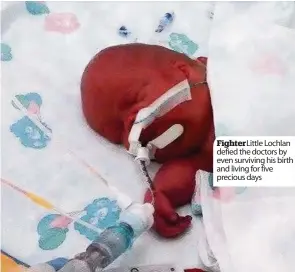  ??  ?? Fighter Little Lochlan defied the doctors by even surviving his birth and living for five precious days