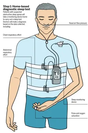  ??  ?? Patients with suspected obstructiv­e sleep apnea will take a monitoring device home to carry out a sleep test. Doctors will make a diagnosis based on the data collected, including: Chest respirator­y effort Abdominal respirator­y effort