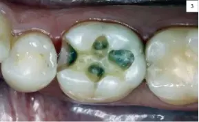  ??  ?? Fig. 3: Tras la eliminació­n de la caries se procede al acabado de la cavidad. Fig. 3: Once the caries had been removed, the cavity was finished. 3