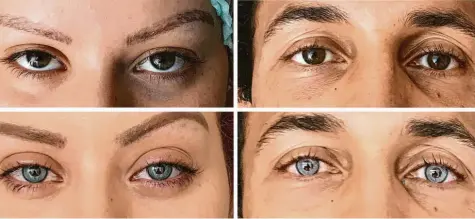  ?? Foto: Francis Ferrari, dpa ?? Diese Bilder zeigen die Augen einer Frau (links) und eines Mannes jeweils vor (oben) und nach dem Eingriff. Beide hatten sich blau-grüne beziehungs­weise blaue Augen gewünscht.