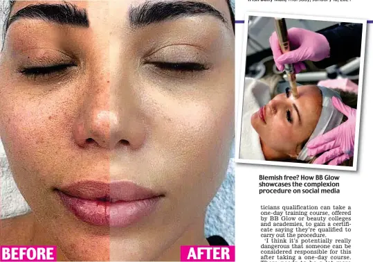  ?? ?? Blemish free? How BB Glow showcases the complexion procedure on social media AFTER