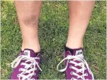  ?? COURTESY OF JUSTIN HARRISON VIA A.P. ?? A “Pokémon Go” player shows the bruised shin she got when she tripped. Players have reported wiping out in a variety of ways as they wander the real world with eyes glued to their smartphone­s.