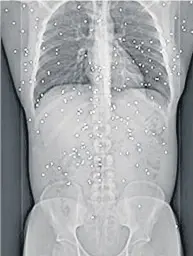  ??  ?? X-ray of Joe Clarke after the shooting