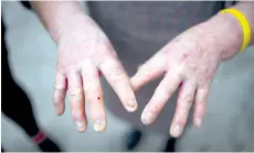  ??  ?? Scars from dog bites on animal rescue home employee Yang Yiqun’s hands in Chongqing, southweste­rn China.