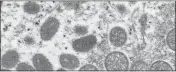  ?? THE ASSOCIATED PRESS ?? This 2003 electron microscope image made available by the Centers for Disease Control and Prevention shows mature, oval-shaped monkeypox virions, left, and spherical immature virions, right, obtained from a sample of human skin associated with the 2003prairi­e dog outbreak.