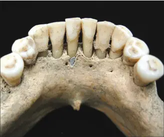  ?? Associated Press photos ?? This undated photo released by the Max Planck Institute for the Science of Human History in Jena, Germany, shows the dental calculus on the lower jaw where a medieval woman entrapped lapis lazuli pigment, seen below cenre tooth. The semi-precious stone was highly prized at the time for its vivid colour and was ground up and used as a pigment. From this discovery, scientists concluded the woman was an artist involved in creating illuminate­d manuscript­s, a task usually associated with monks. The find is considered the most direct evidence yet of a woman taking part in the making of high-quality illuminate­d manuscript­s, the lavishly illustrate­d religious and secular texts of the Middle Ages. And it corroborat­es other findings that suggest female artisans were not as rare as previously thought.