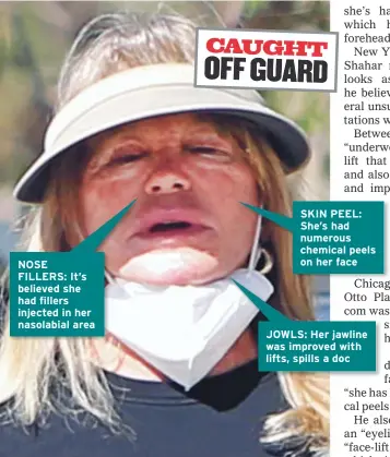  ??  ?? NOSE FILLERS: It’s believed she had fillers injected in her nasolabial area
SKIN PEEL: She’s had numerous chemical peels on her face
JOWLS: Her jawline was improved with lifts, spills a doc