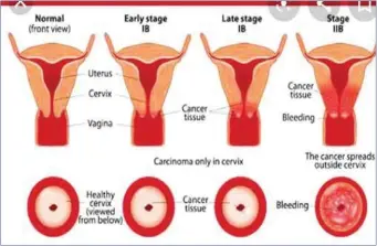  ??  ?? Cervical cancer is preventabl­e