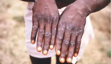  ?? Reuters ?? The hands of a patient with a rash due to monkeypox, in this image obtained on Wednesday.