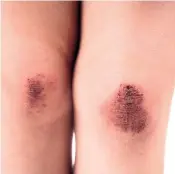  ?? TNS ?? It’s important to clean and treat skin abrasions properly to avoid infection.