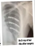  ?? ?? An X-ray of her ribs after surgery