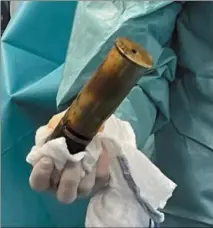  ?? (Photo DR) ?? Une personne âgée a été opérée à l’hôpital Sainte-Musse de Toulon pour retirer un obus de cinq à six centimètre­s de diamètre sur vingt de long, introduit dans son postérieur.