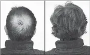  ??  ?? Breakthrou­gh research proves this discovery helps fill-in bald spots, re-nournishes thinning hair, and leads to noticeable growth in as little as 30 days.