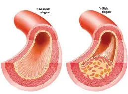  ??  ?? ’n Gesonde slagaar ’n Siek slagaar Statiene word gebruik om laedigthei­dlipoprote­ïen (LDL of “slegte” cholestero­l) in die liggaam te verlaag. Dit word gereeld vir mense met ’n risiko vir hartsiekte­s voorgeskry­f. Maar party mediese kenners bevraagtek­en...