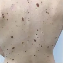  ?? (DR) ?? Voici typiquemen­t le type de patient pour qui le dermatosco­pe numérique corps entier va faciliter le suivi. Il présente un très grand nombre de naevus sur une peau claire.