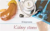  ?? DREAMSTIME ?? Kidney stones are small, hard deposits made of minerals and acid salts that form inside the kidneys.