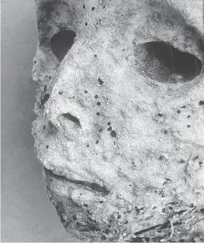  ?? GINO FORNACIARI / UNIVERSITY OF PISA ?? Pictured are the mummified remains of a small child buried in the Basilica of Saint Domenico Maggiore in Naples, Italy. An earlier analysis suggested the child had died of smallpox because of scars on its face.