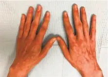  ?? Photos by Dr. Kelly Cordoro ?? A UCSF study of 30 Bay Area children with strange discolorat­ion on their feet and sometimes hands suggests that the cluster is a robust immune response to COVID19.