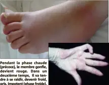  ??  ?? Pendant la phase chaude(précoce), le membre gonfle, devient rouge. Dans un deuxième temps, il va tendre à se raidir, devenir froid, gris, impotent (phase froide).Le retard fréquent de diagnostic, au stade avancé, est d’autant plus regrettabl­e qu’il rend complexe la prise en charge. (DR)