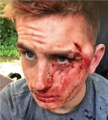  ??  ?? Terrified: Dylan Swan after he was beaten, kicked and knifed by a mob of thugs