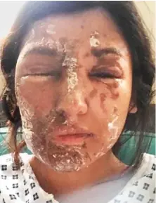  ??  ?? Disfigured: Resham Khan received horrific burns