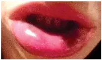  ??  ?? Painful: Miss Jarosz’s lips after the treatment