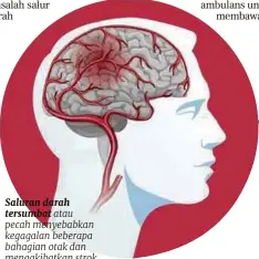  ??  ?? Saluran darah tersumbat atau pecah menyebabka­n kegagalan beberapa bahagian otak dan mengakibat­kan strok.