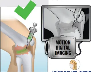  ??  ?? JRI Doctors see live into the knee joint. Even you will be able to tell the medicine is flowing where it needs to be. No guess work, no poking around, the medicine cushions, lubricates and helps heal the damaged knee.