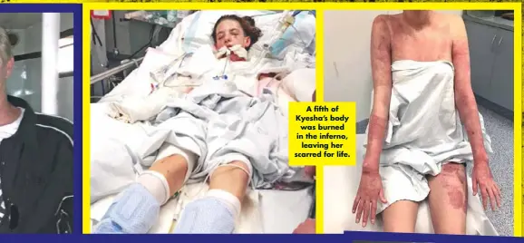  ??  ?? A fifth of Kyesha’s body was burned in the inferno, leaving her scarred for life.
