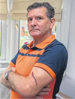  ?? Picture: Steven Brown. ?? Chainsaw attack victim Arthur Innes at home in Dundee with scars visible from the horrific incident.