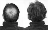  ??  ?? Breakthrou­gh research proves this discovery helps fill-in bald spots, re-nournishes thinning hair, and leads to noticeable growth in as little as 30 days.