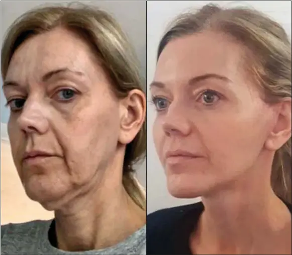  ??  ?? REAL TRANSFORMA­TION: Mel Beard, left, before her face and neck procedure and, right, her new ‘smoothed, brighter version of myself’