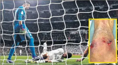  ??  ?? FEA HERIDA. Varane mostró en Instagram el golpe que recibió en la acción en la que marcó en propia puerta.