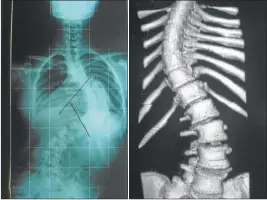  ?? GZA: MSAL BA ?? CURVATURA. Las imágenes de rayos X muestran la desviación de la columna que se produce con esta patología. Afecta más a las mujeres.