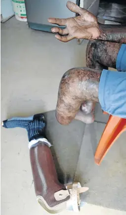  ?? /ZIPHOZONKE LUSHABA ?? The day the Soweto man will never forget. He lost his leg and suffered severe burns.