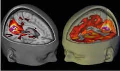  ??  ?? Mente dopada.
Un método eficaz de provocar alucinacio­nes es tomar drogas. Científico­s del Imperial College de Londres escanearon el cerebro de un consumidor de LSD –derecha– y vieron que se conectaban zonas normalment­e incomunica­das, como las...