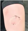  ??  ?? Christophe­r Hill’s teeth marks on the officer’s arm