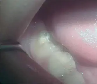  ??  ?? Figura 1. Pérdida de estructura adamantina en el surco vestibular del 1º molar permanente (46), correspond­iendo a un esmalte hipominera­lizado de color amarillent­o/ marrón, grado II.