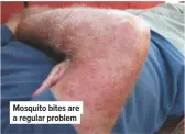  ??  ?? Mosquito bites are a regular problem