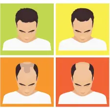  ??  ?? Hair loss usually begins at the temples, with the hairline gradually receding