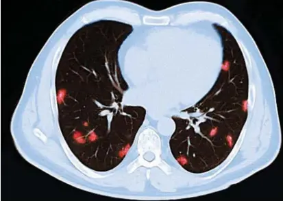  ?? © ?? CT-scan van de aangetaste longen van een 66-jarige coronapati­ënt. belga