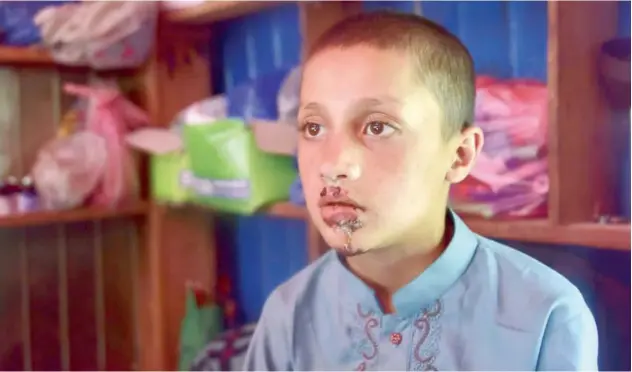  ?? Associated Press ?? ↑ A Kashmiri boy shows his injuries near Muzaffarab­ad on Sunday.